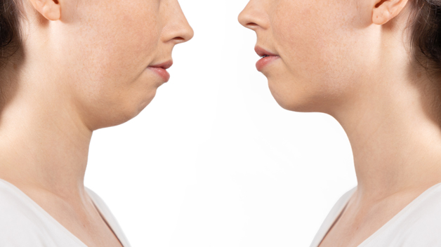 Jaw Surgery