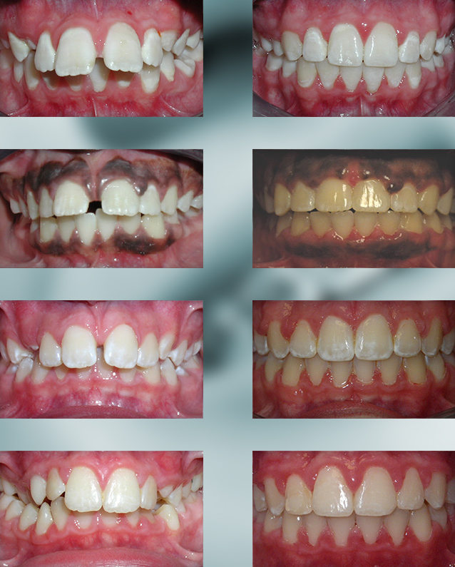 Protrusion Teeth